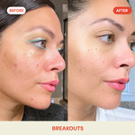 Hypochlorous Acid Facial Spray for Acne, Eczema, Rosacea