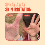 Hypochlorous Acid Facial Spray for Acne, Eczema, Rosacea