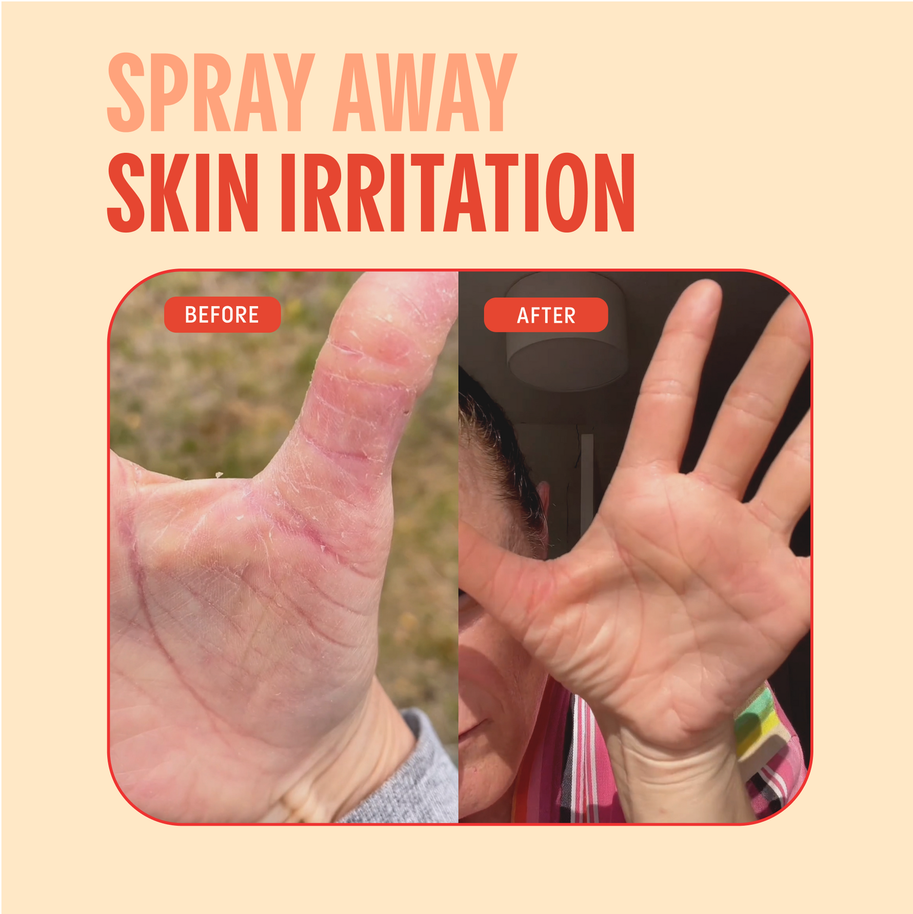 Hypochlorous Acid Facial Spray for Acne, Eczema, Rosacea