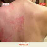 Hypochlorous Acid Facial Spray for Acne, Eczema, Rosacea