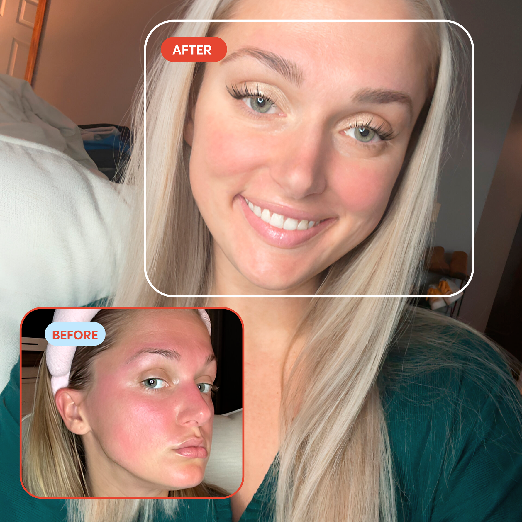 Hypochlorous Acid Facial Spray for Acne, Eczema, Rosacea